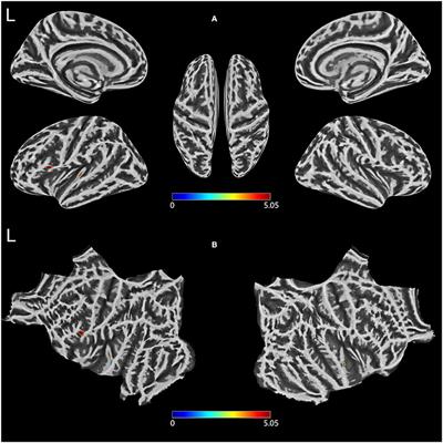 Altered cortical thickness, degree centrality, and functional connectivity in middle-age type 2 diabetes mellitus